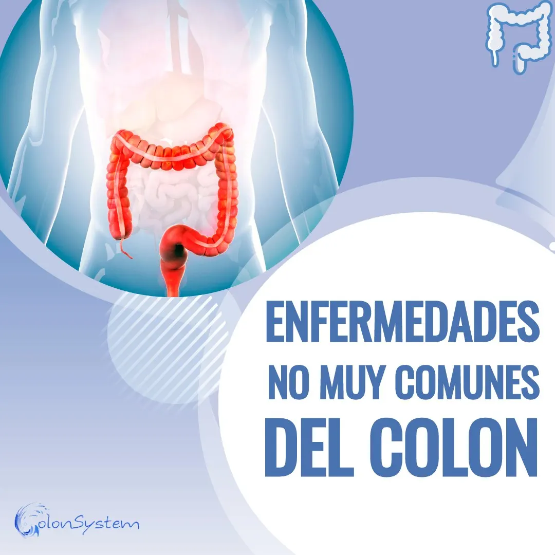 Enfermedades no muy comunes del colon